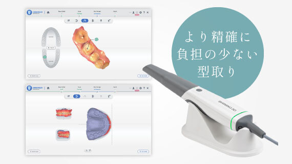 より精確に負担の少ない型取り