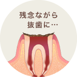残念ながら　抜歯に…