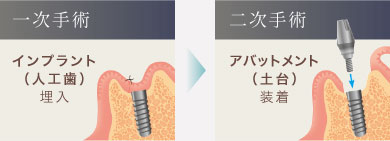 一次手術：インプラント埋入・二次手術：アバットメント装着