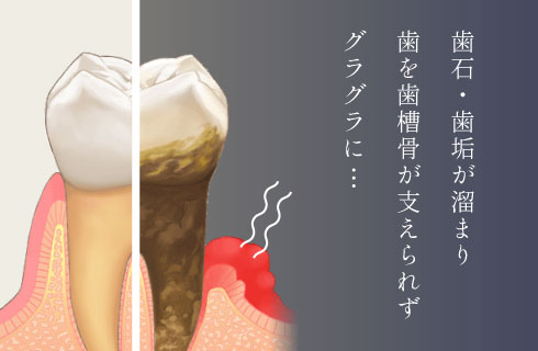 歯石・歯垢が溜まり歯を歯槽骨が支えられずグラグラに
